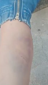 Cháu bé bầm tím khắp người ở Nghệ An: Công an vào cuộc xác minh
