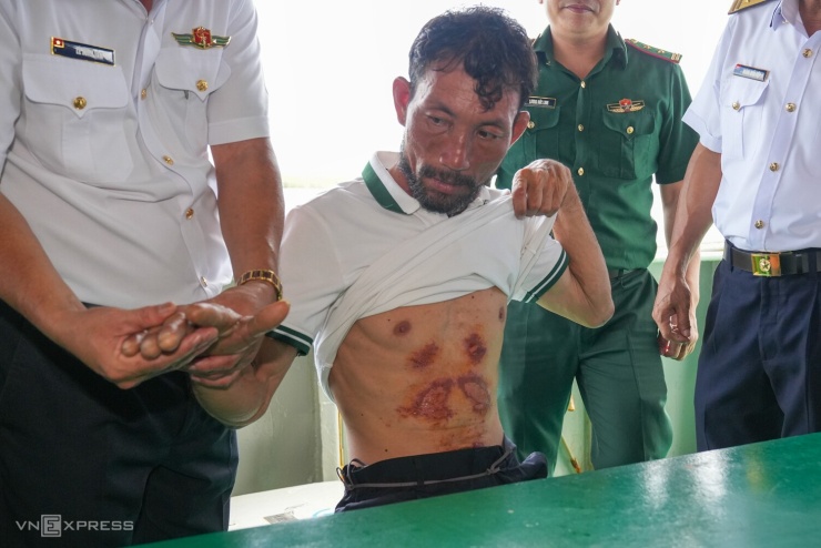 Ông Trung với nhiều vết xước ở bụng do ma sát với bề mặt tấm xốp. Ảnh: Trường Hà