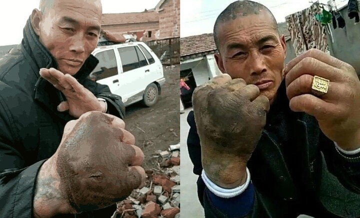 Bàn tay phải của Trần Văn Chúc biến dạng, đổi màu do tập Thiết Sa Chưởng trong hơn 20 năm